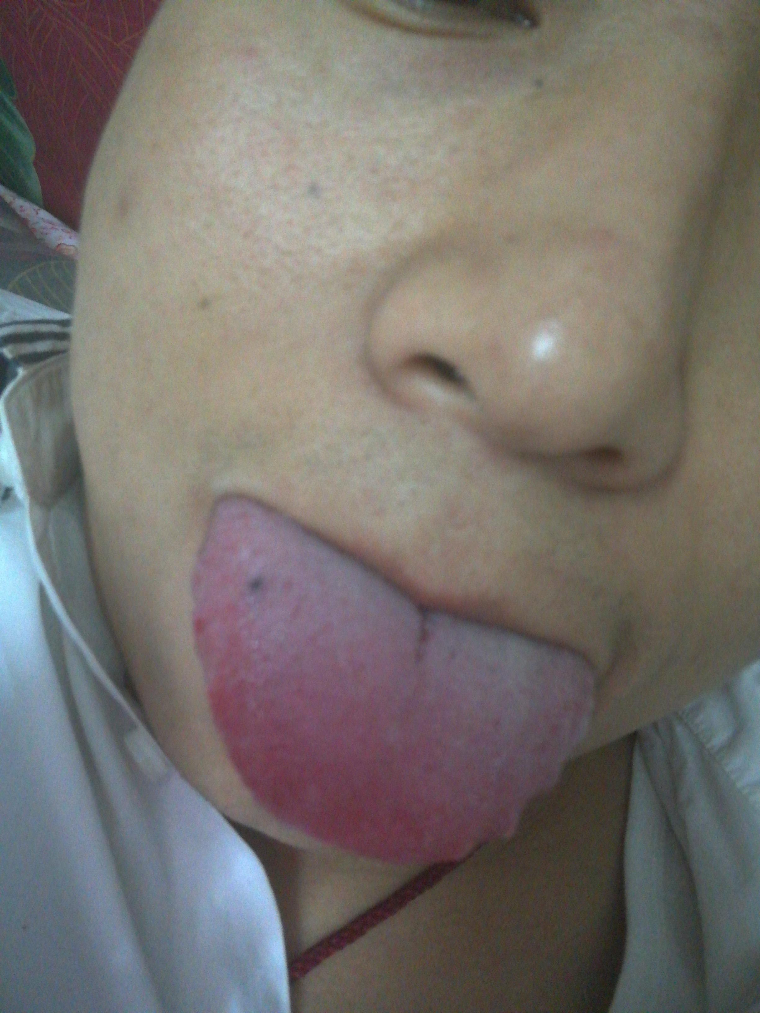 舌头上长黑血泡是癌症图片