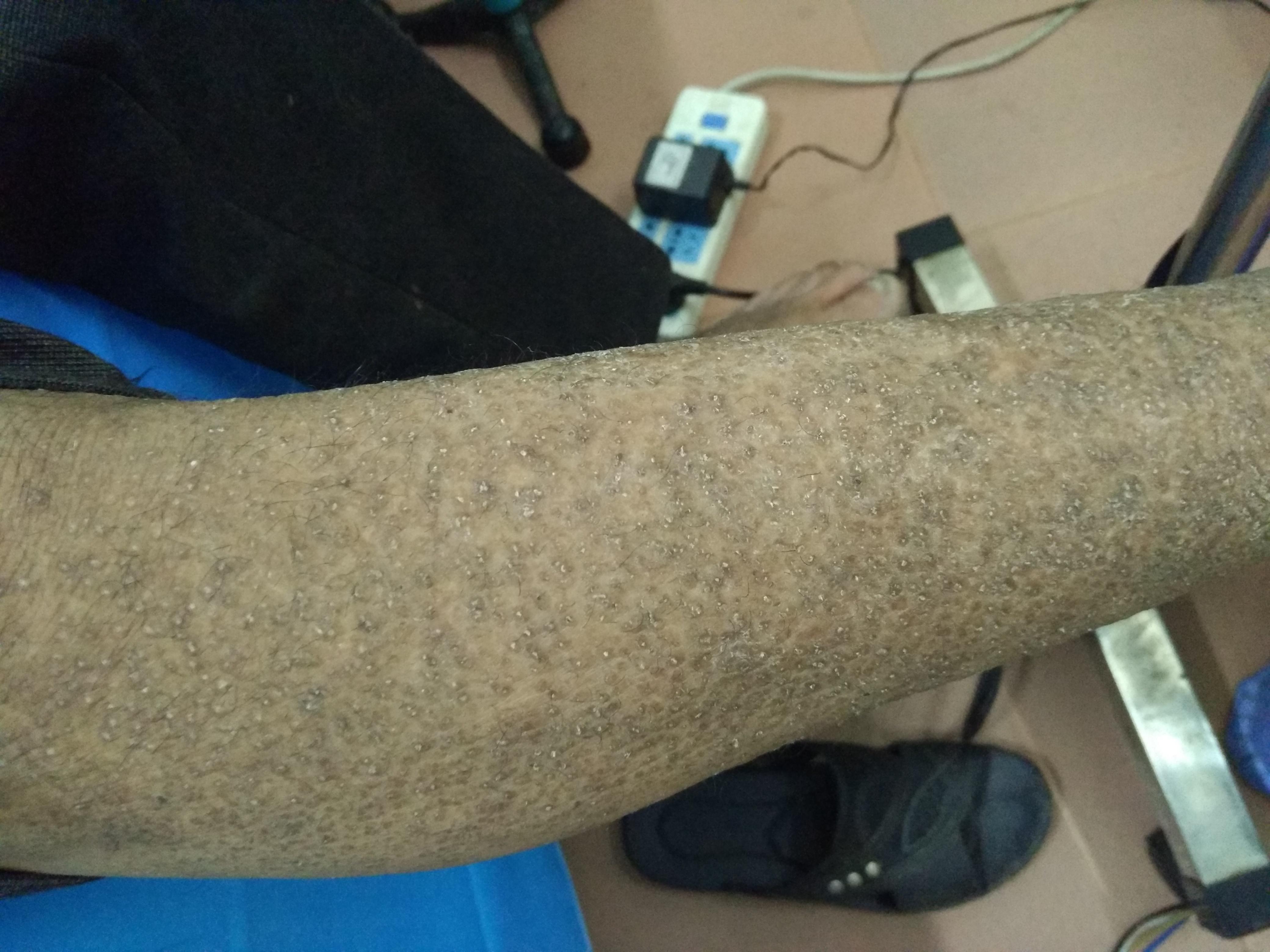 皮肤病问题请教