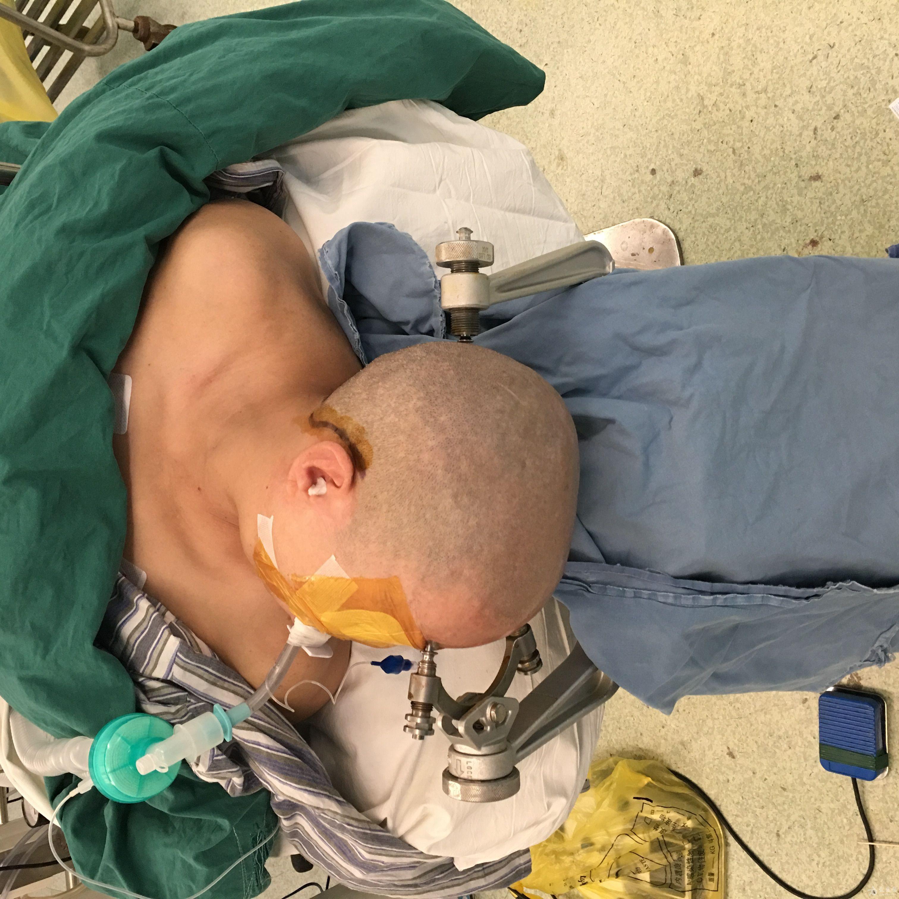 分享一例听神经瘤切除病例原创