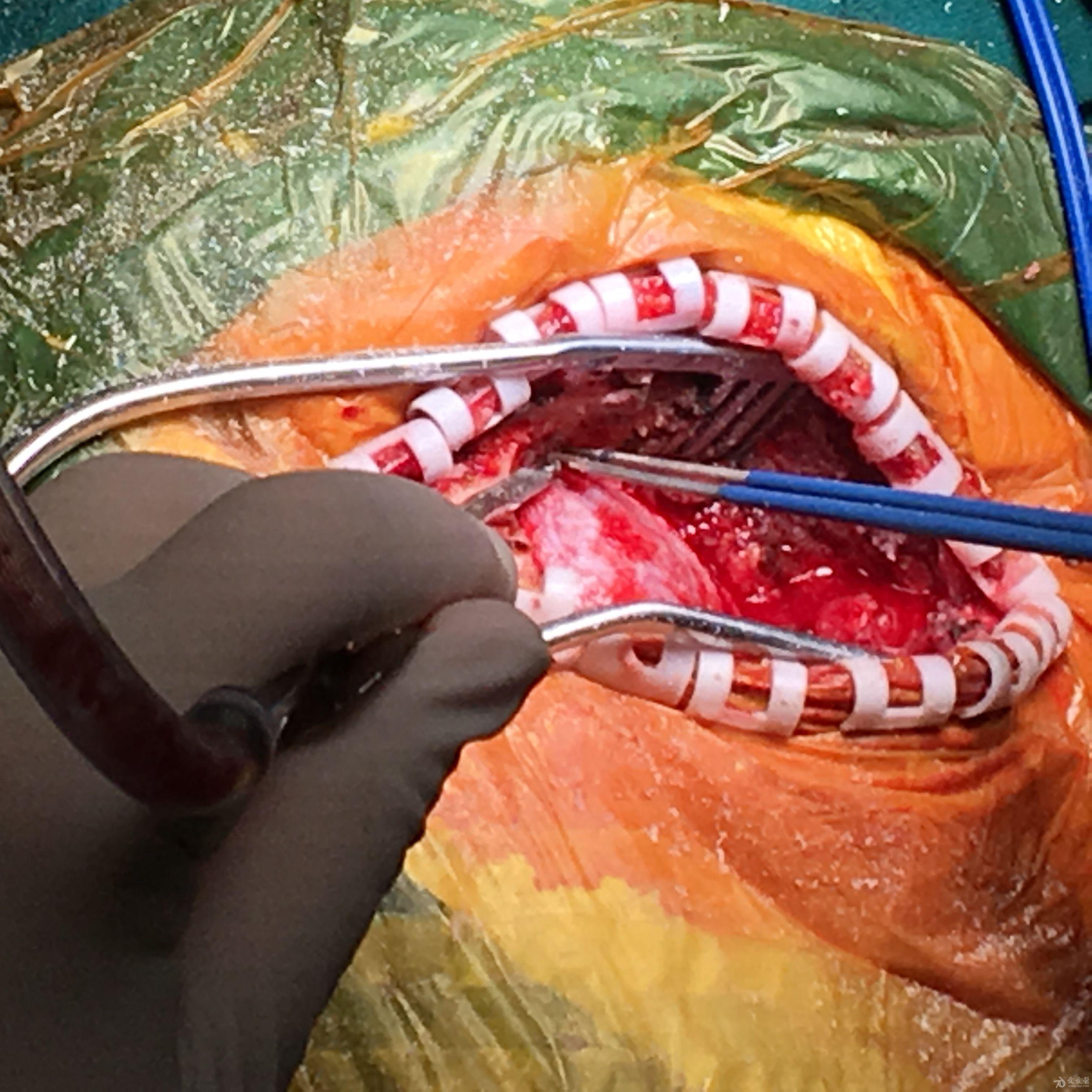 分享一例听神经瘤切除病例原创