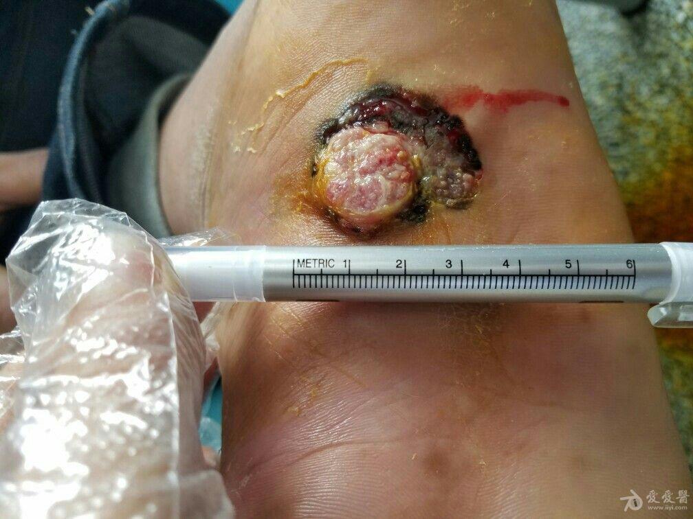 脚底肿瘤图片