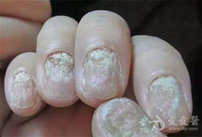 有奖猜图,积分大派送——141甲真菌病