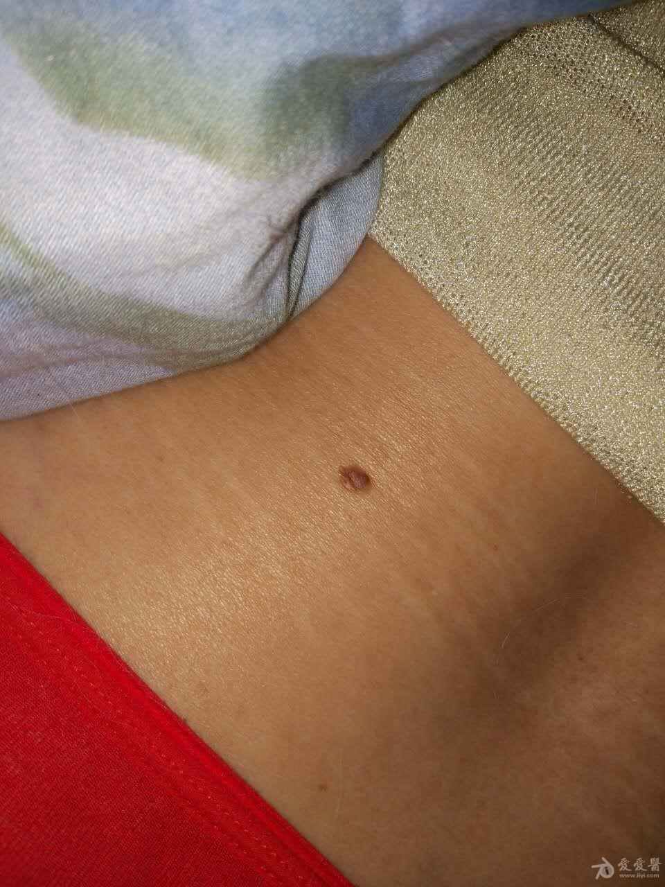 60岁背部隆起,5mm请问是什么?