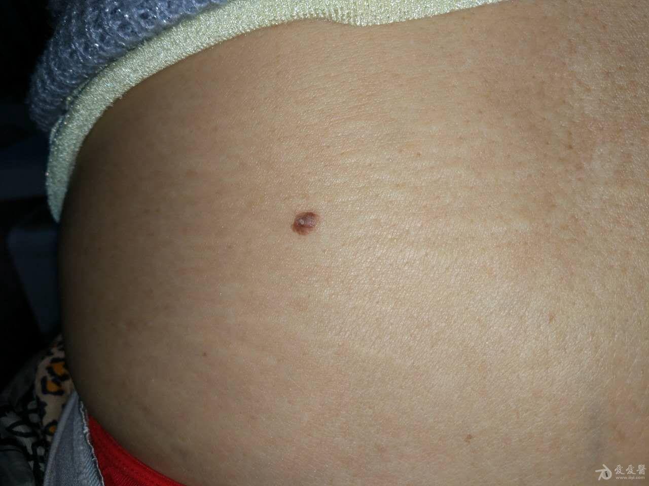 60岁背部隆起,5mm请问是什么?