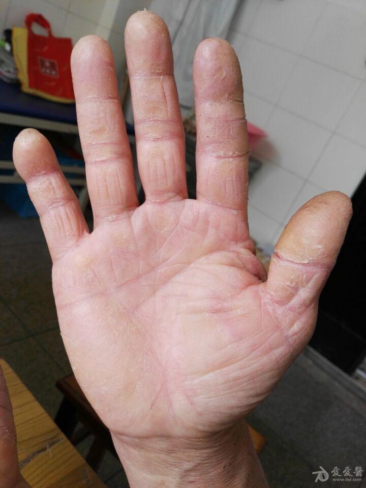 双手皮肤粗糙裂痕伴瘙痒10年余