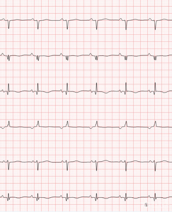冬秋心电图讨论20170423i导联p波倒置