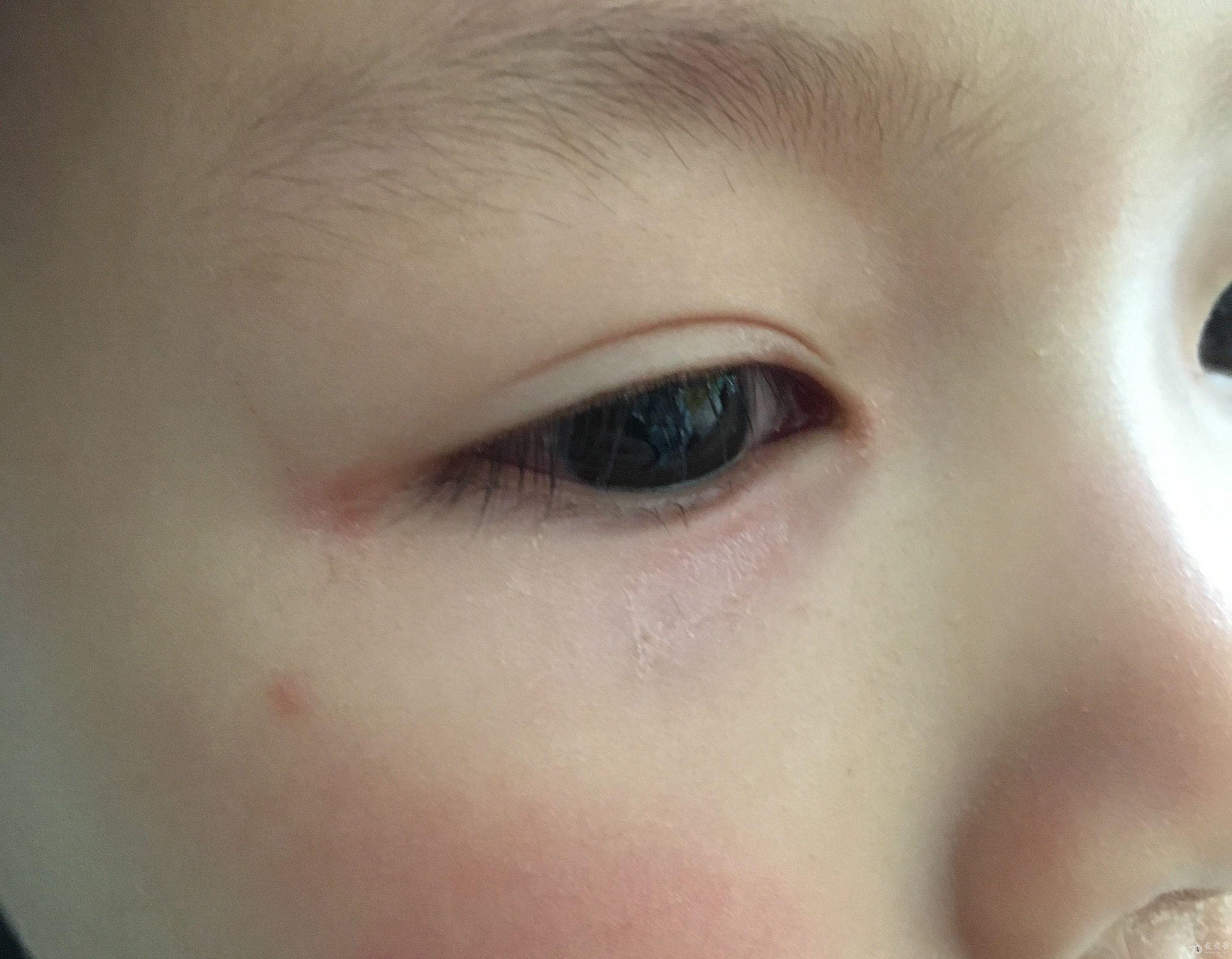 川崎病眼球发红图片图片