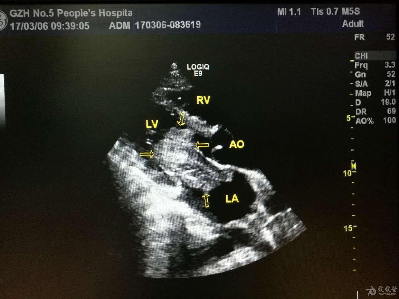 心脏粘液瘤超声图片