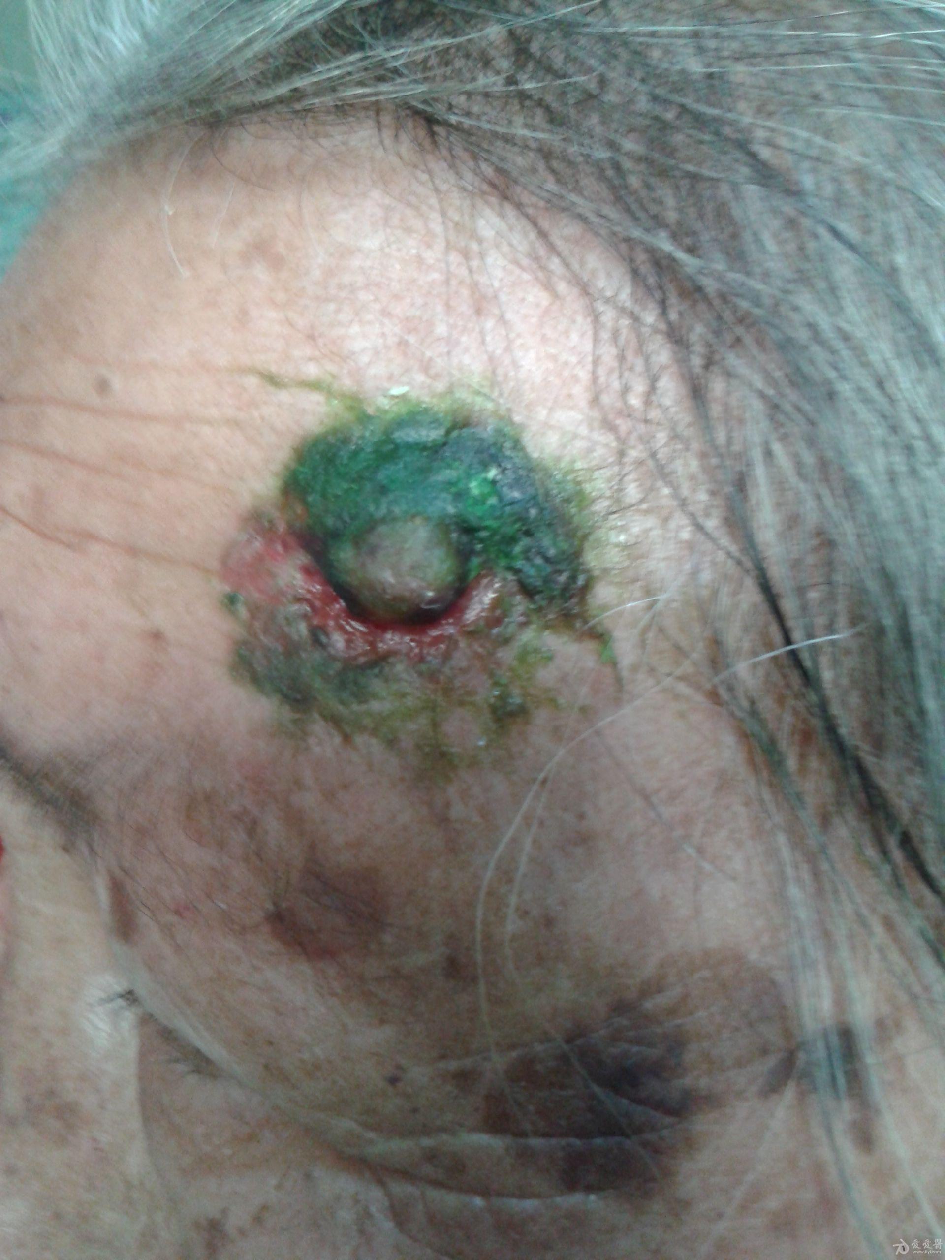 鳞状皮肤癌早期症状图片