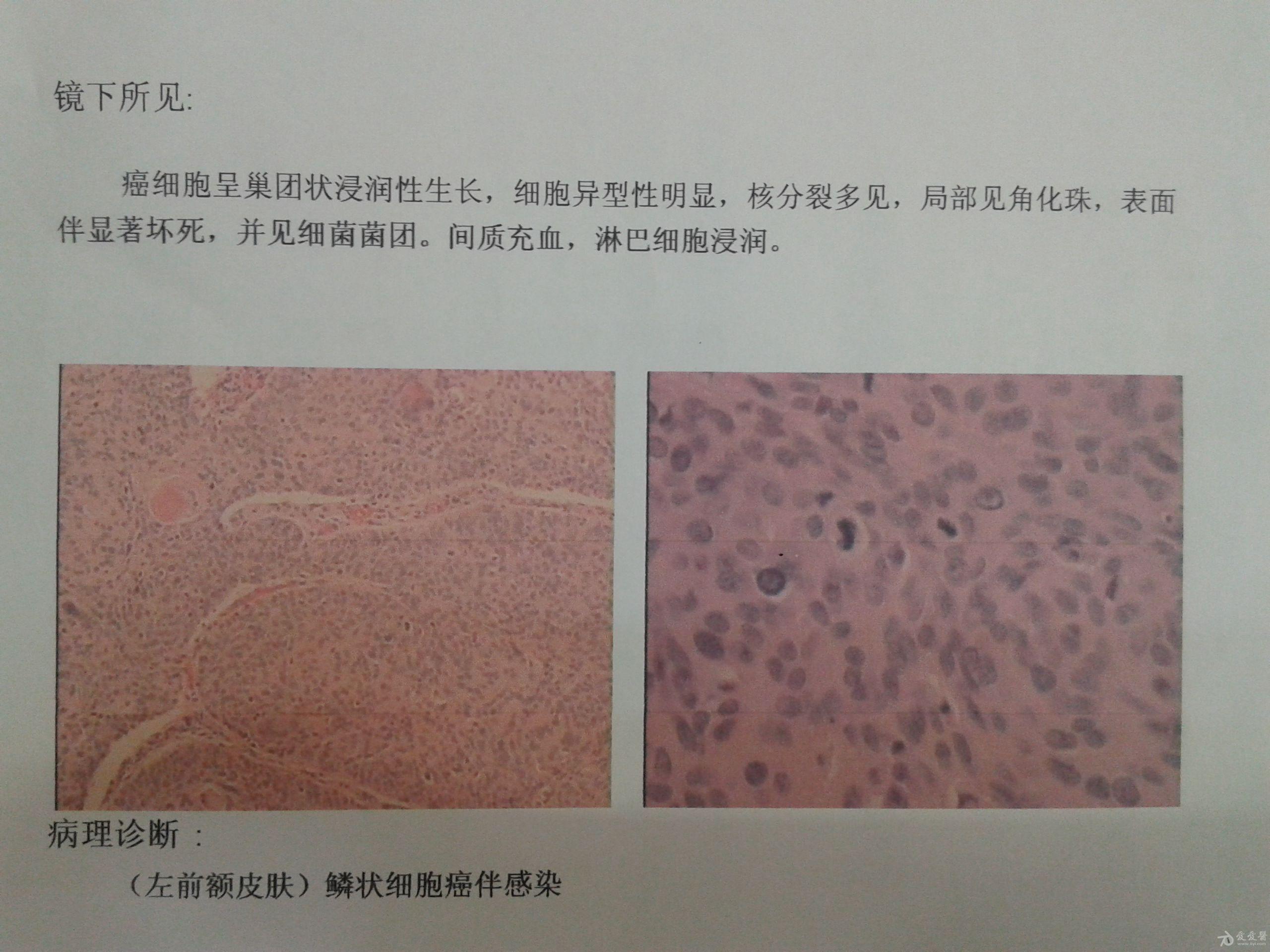 鳞状细胞癌切片图片