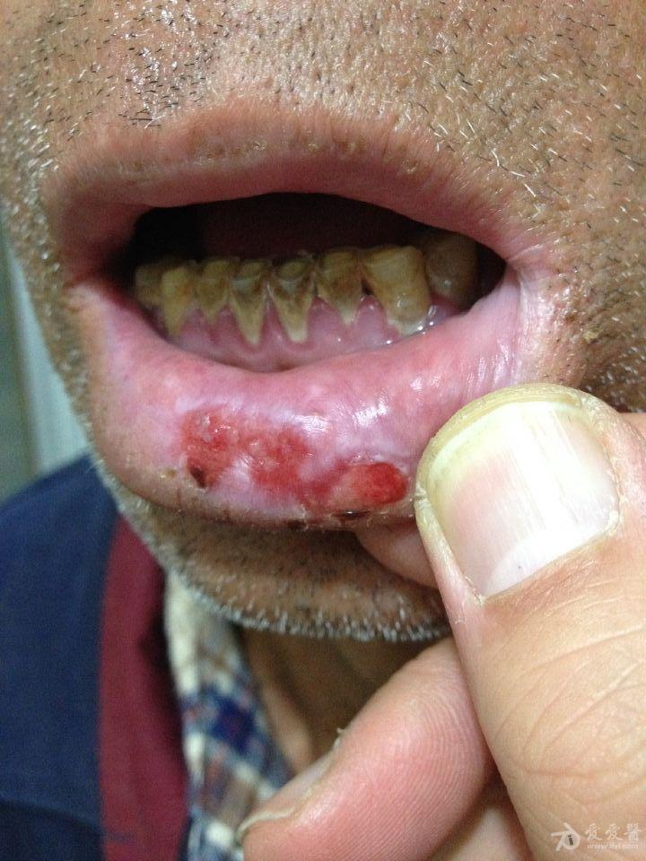 有奖猜图积分大派送191扁平苔癣