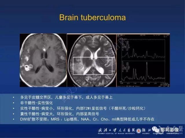 顱內梅毒樹膠腫影像診斷