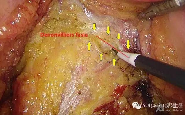 图解从泄殖腔演变看邓氏筋膜到底是一层还是两层