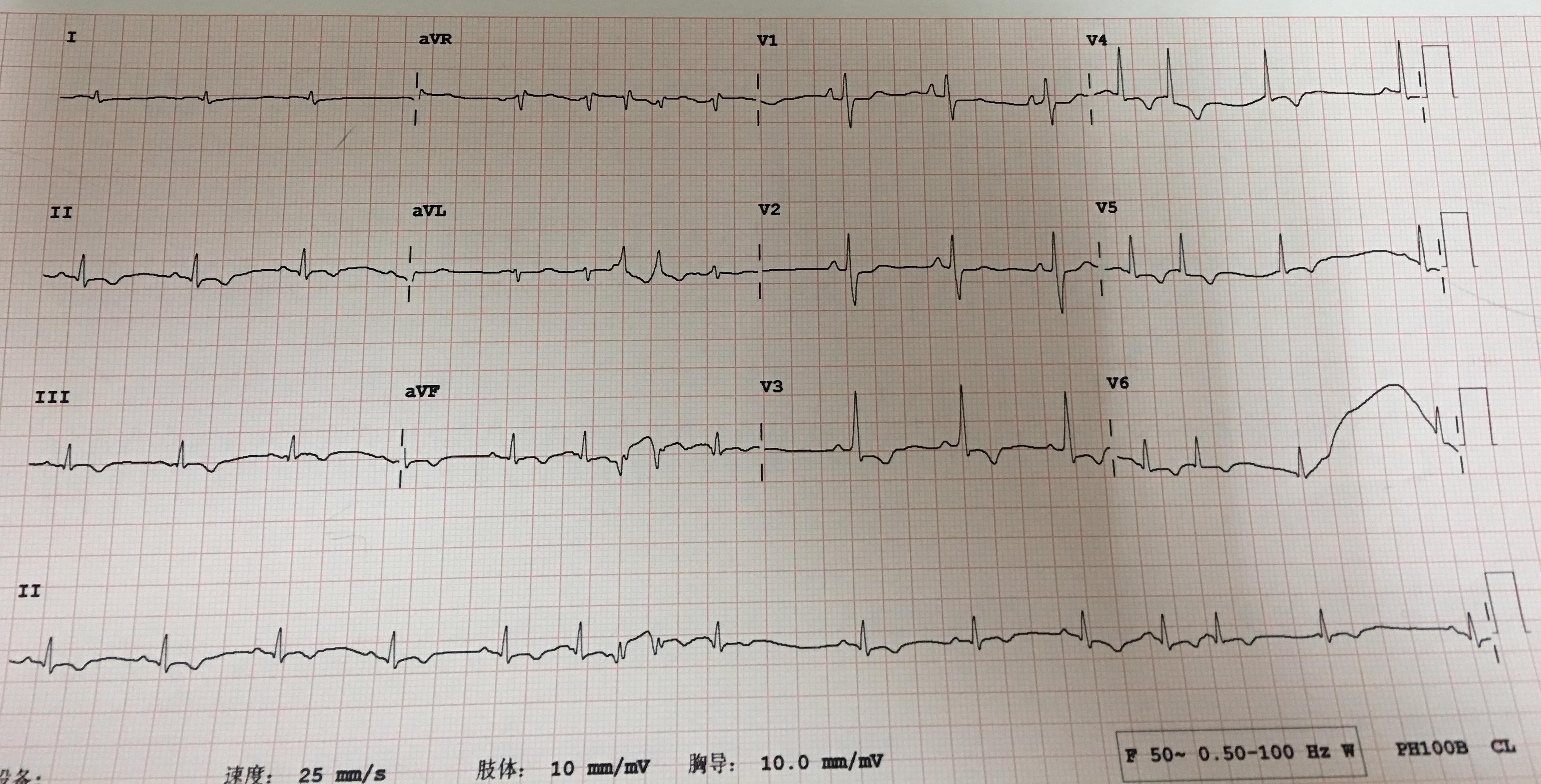 房颤伴间歇性预激综合征?房扑?