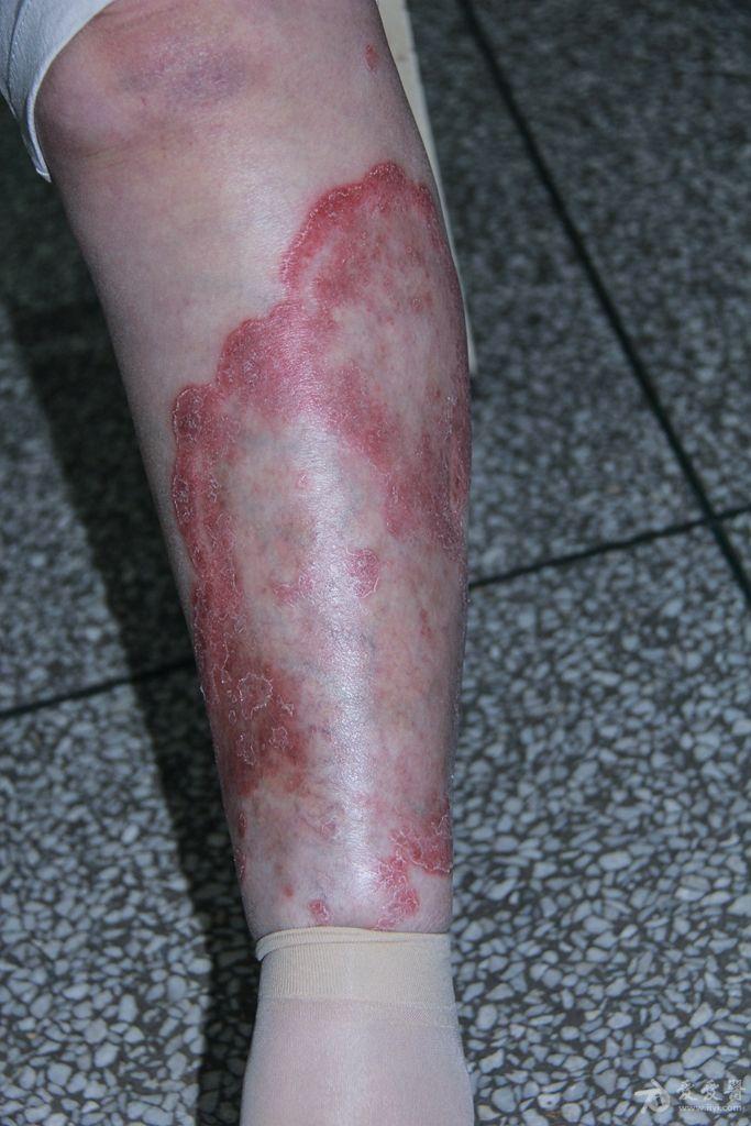 银屑病的环形皮损