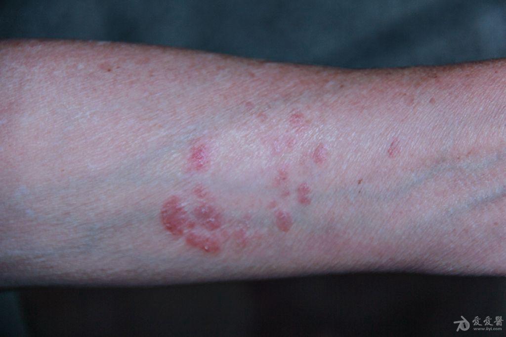 银屑病的环形皮损