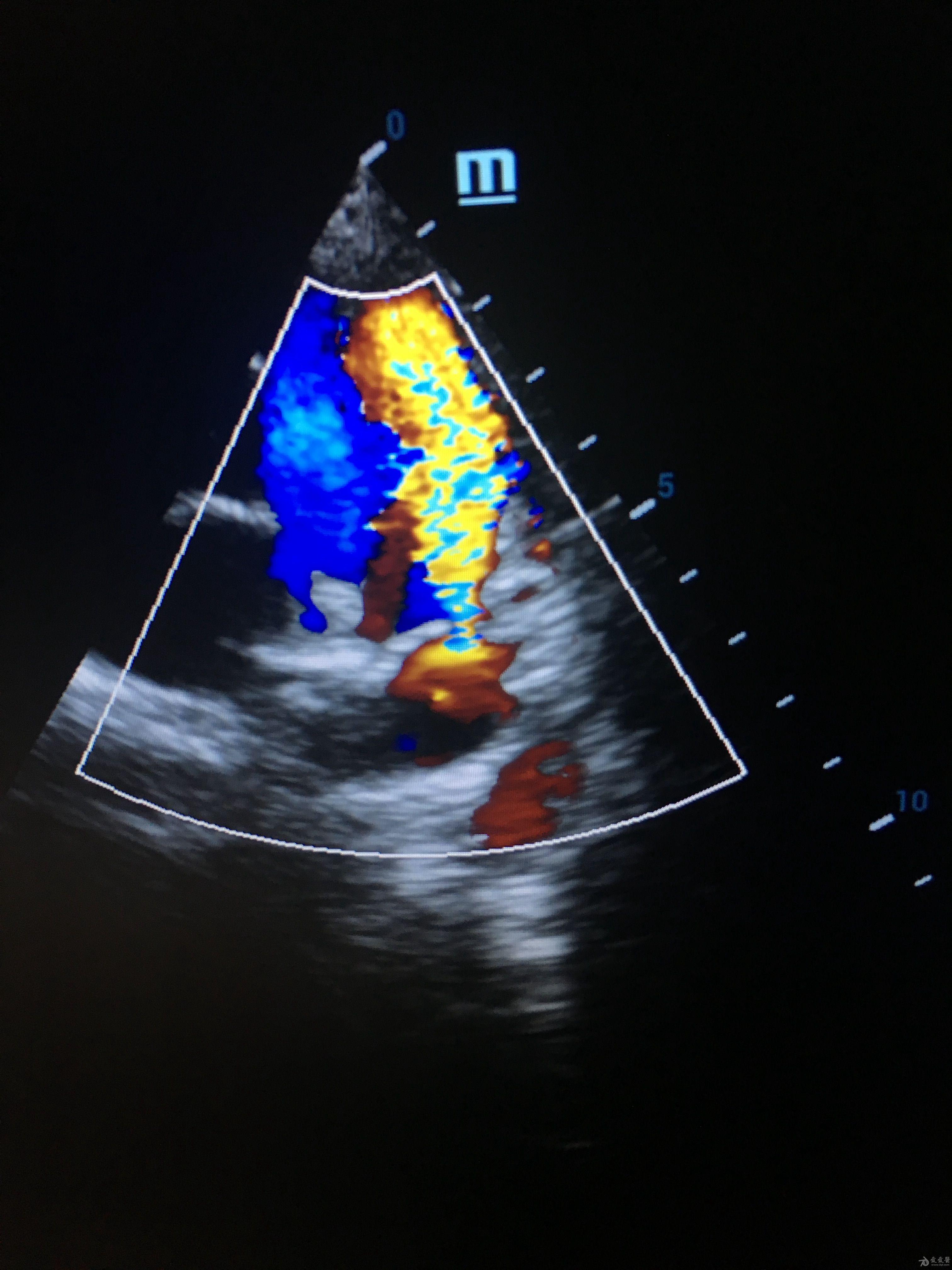 动脉导管未闭彩超图片