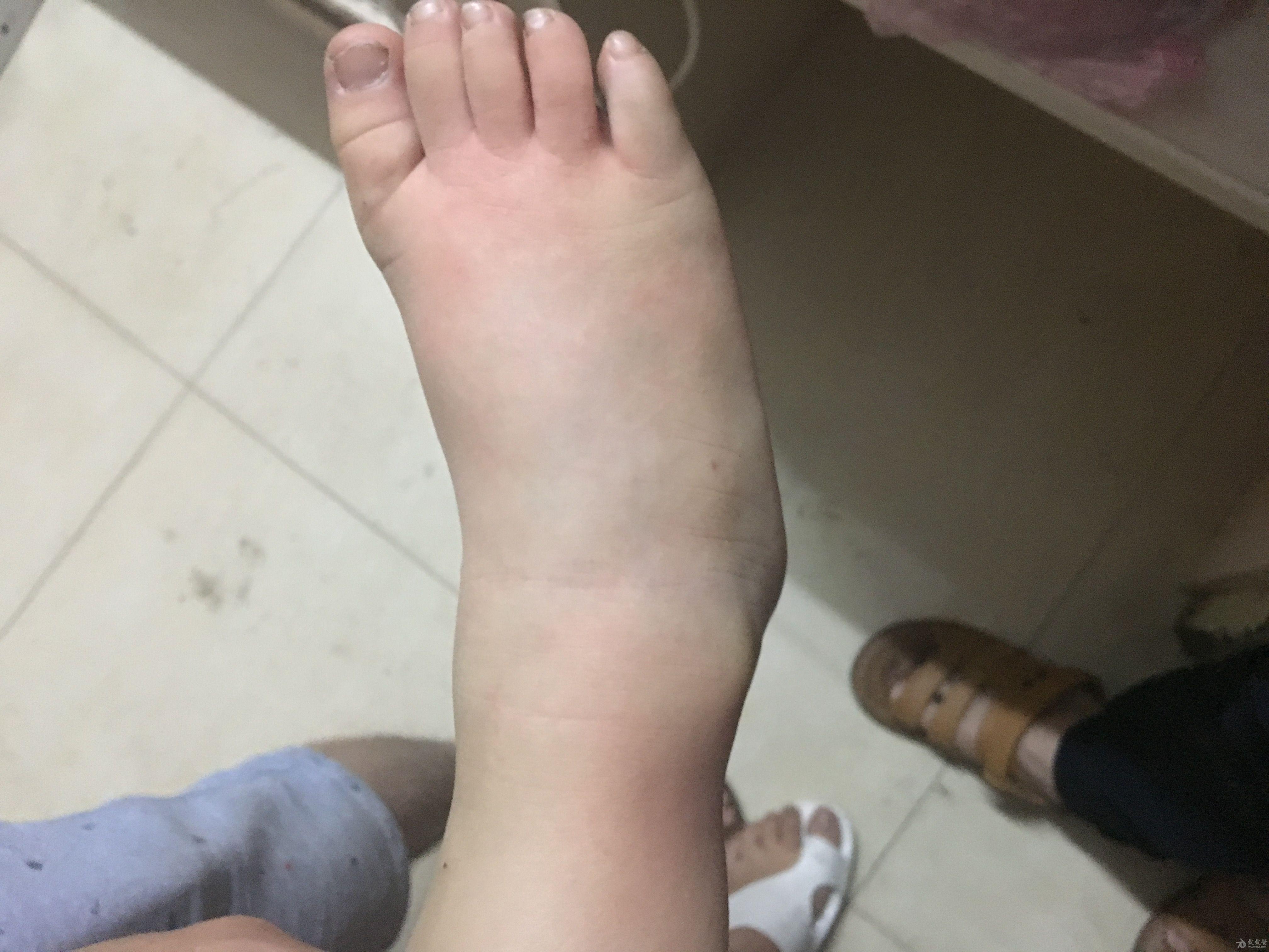 发热与皮疹6发热2天皮疹1天原一一一猩红热