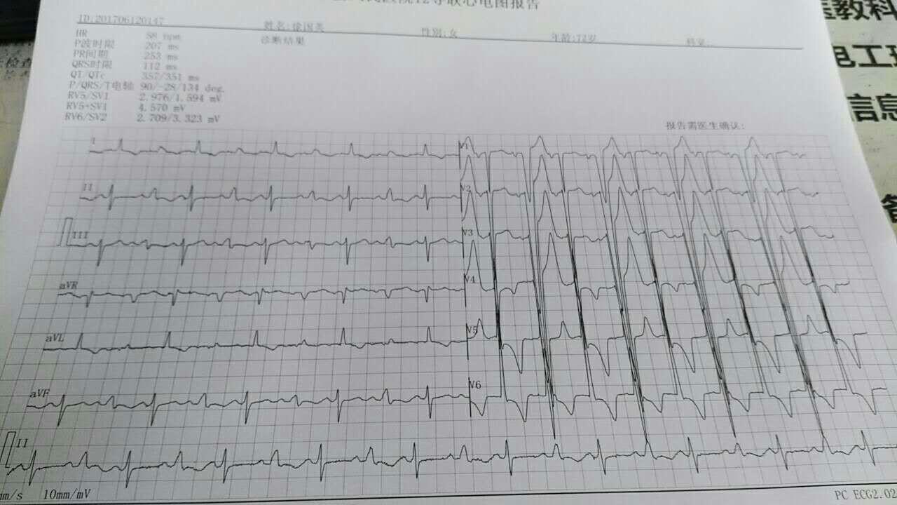 各位老師,室早二聯律? - 心電圖腦電圖專業討論版 - 愛愛醫醫學論壇