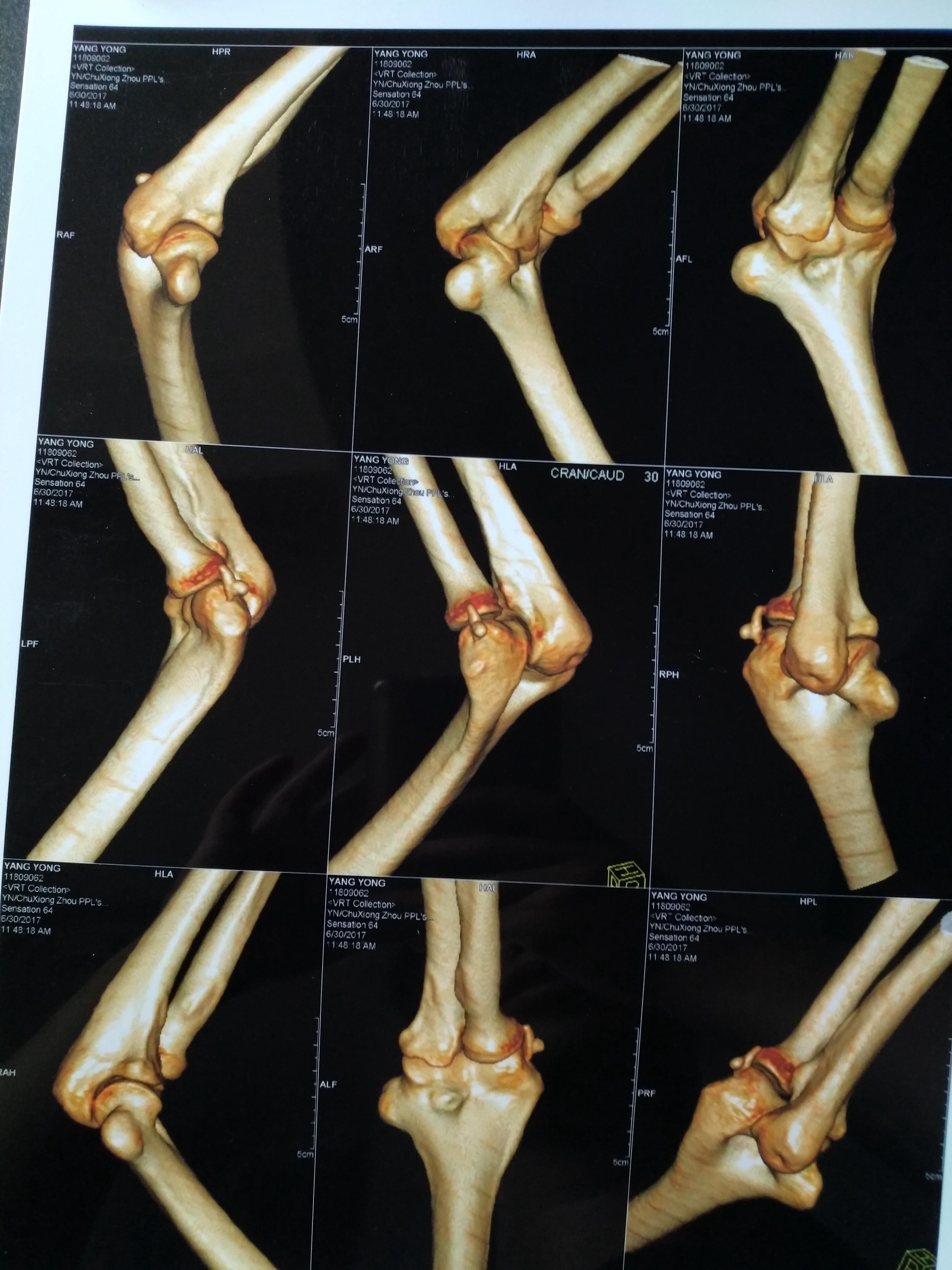 肘关节横断解剖图CT图片