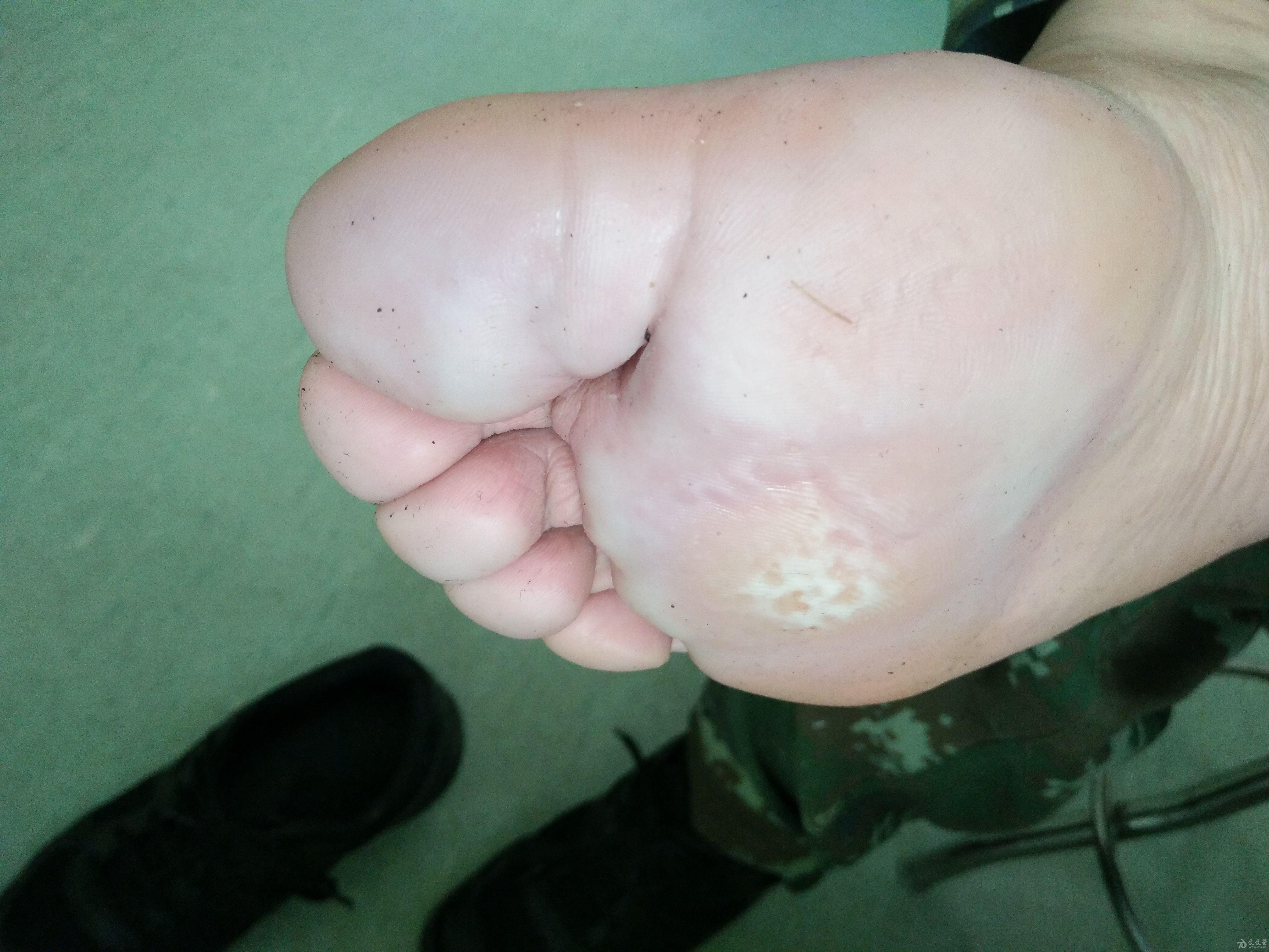 典型病例汗渍性跖部红斑疼痛症