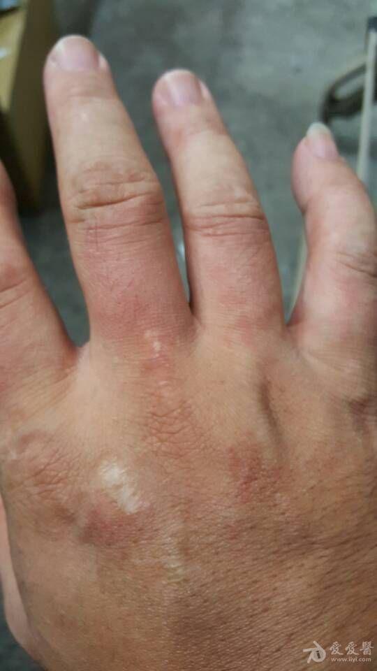 手足红斑会痒