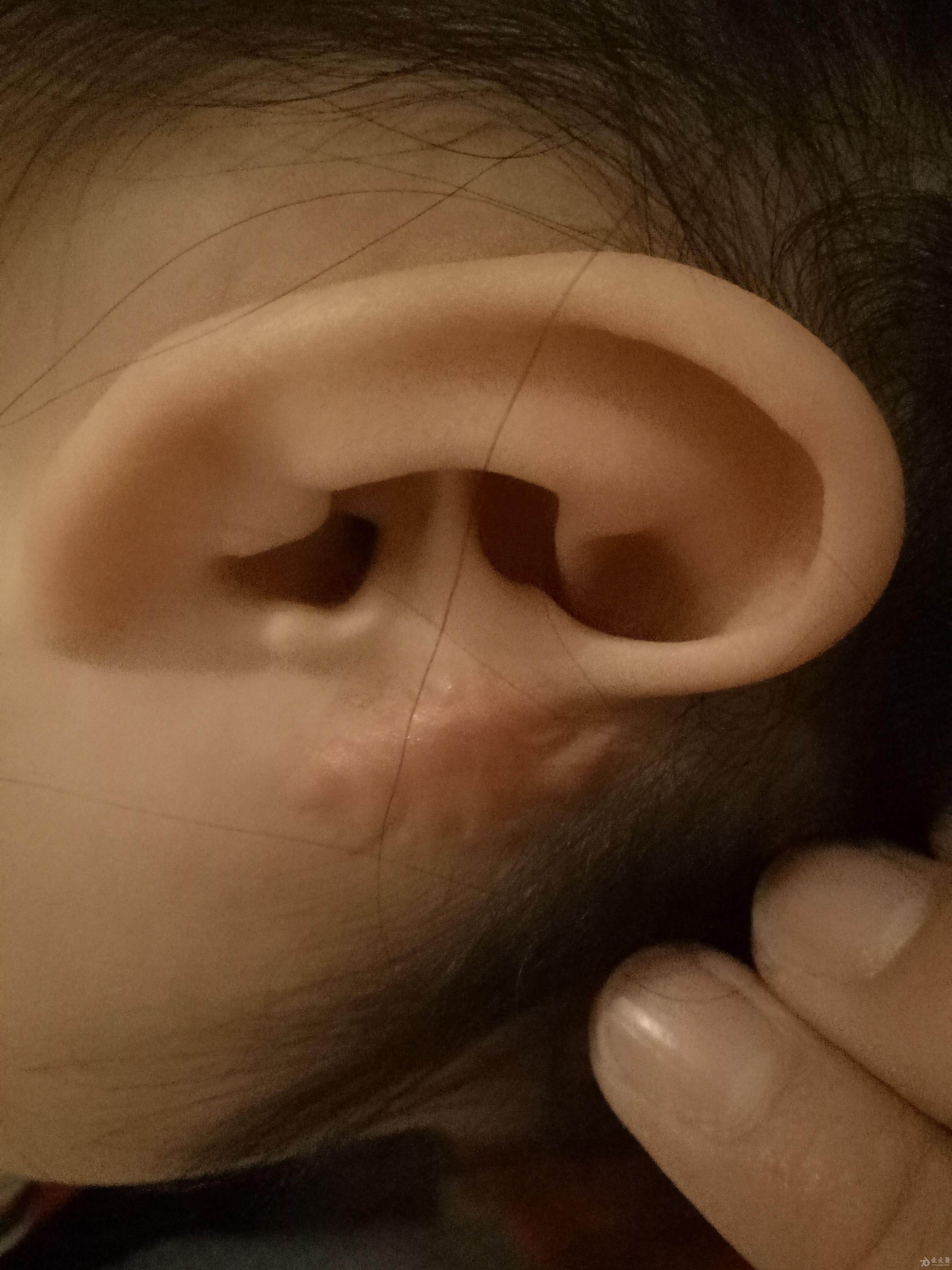 耳前瘘管手术后疤痕图片