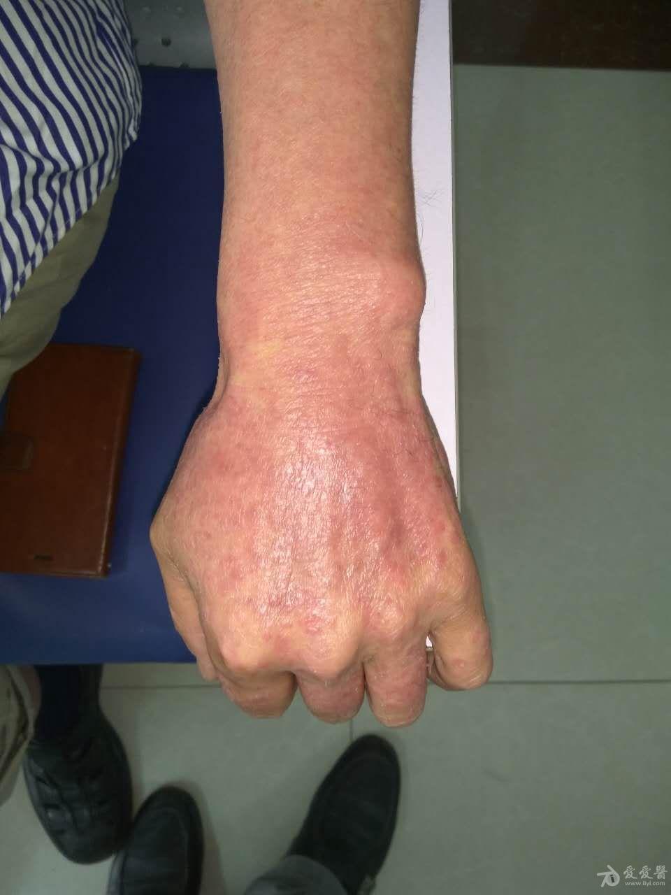 15年庆《全科皮肤病看图诊疗》—反复出现红斑,鳞屑样皮疹15年(27)