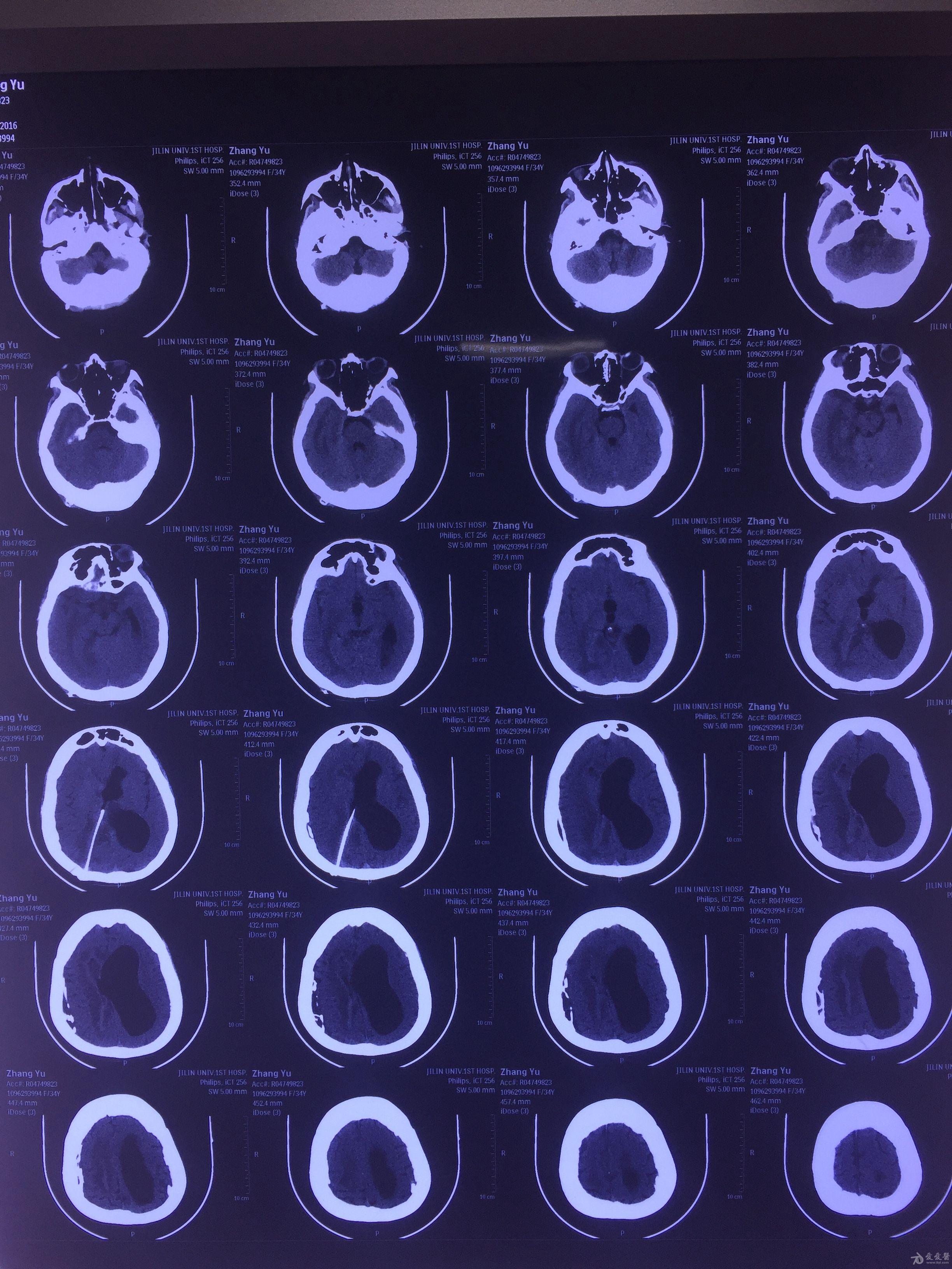 脑积水ct图片图片