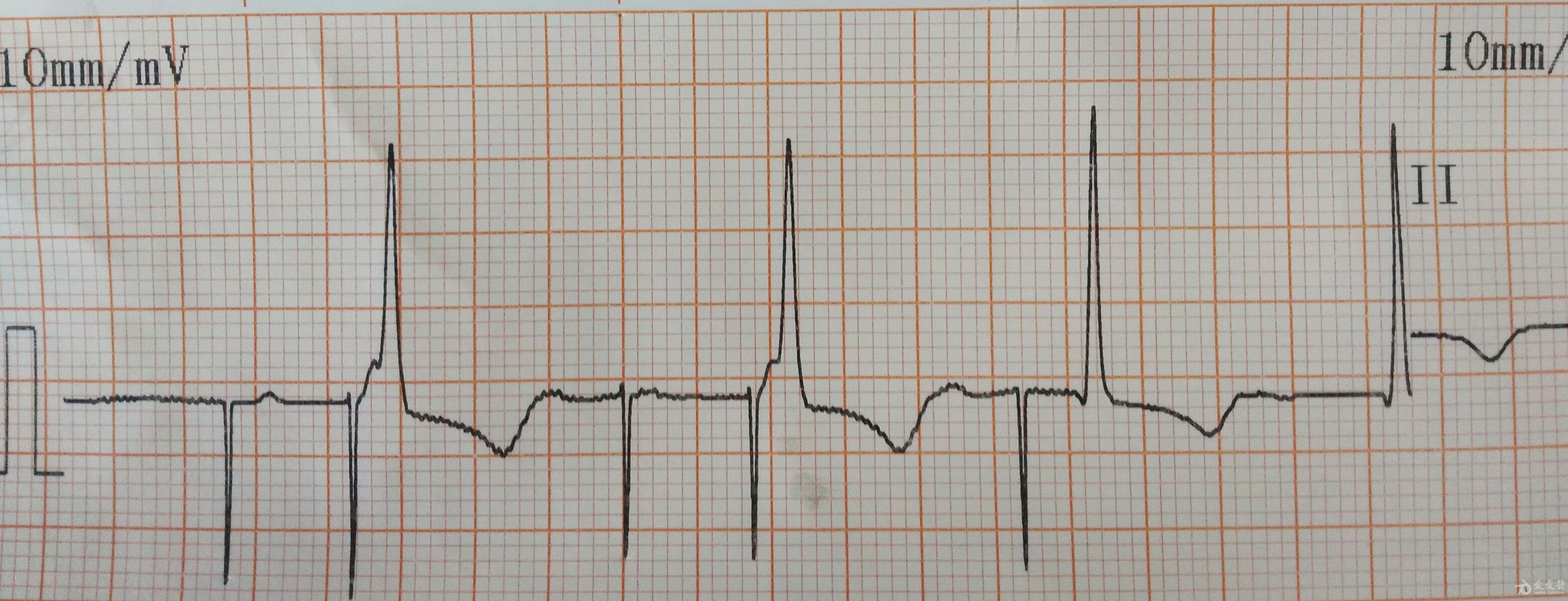 心脏起搏器心电图波形图片