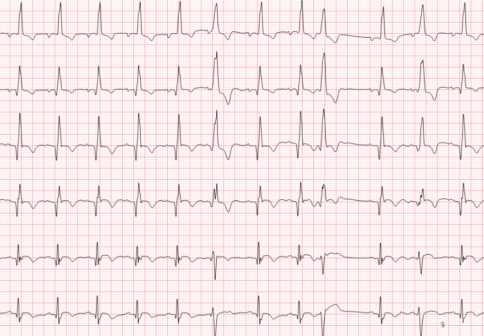 双束支阻滞-室早-ptfv-男性81岁-008.png