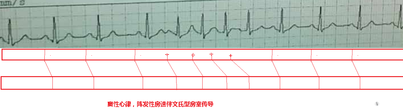 各位老师帮忙看个心电图 谢谢