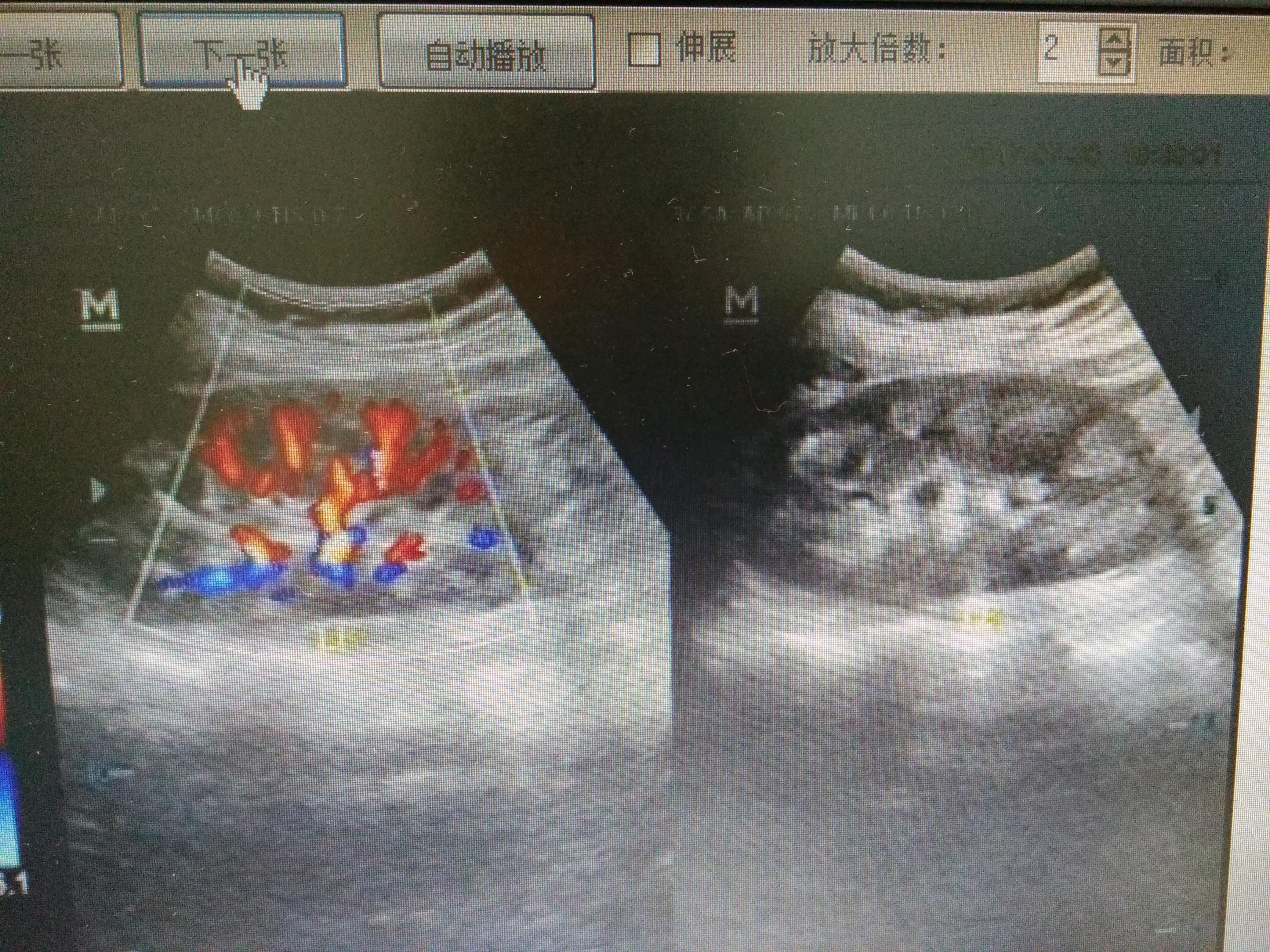 这个是海绵肾?可以诊断吗 - 超声医学讨论版 - 爱爱医医学论坛