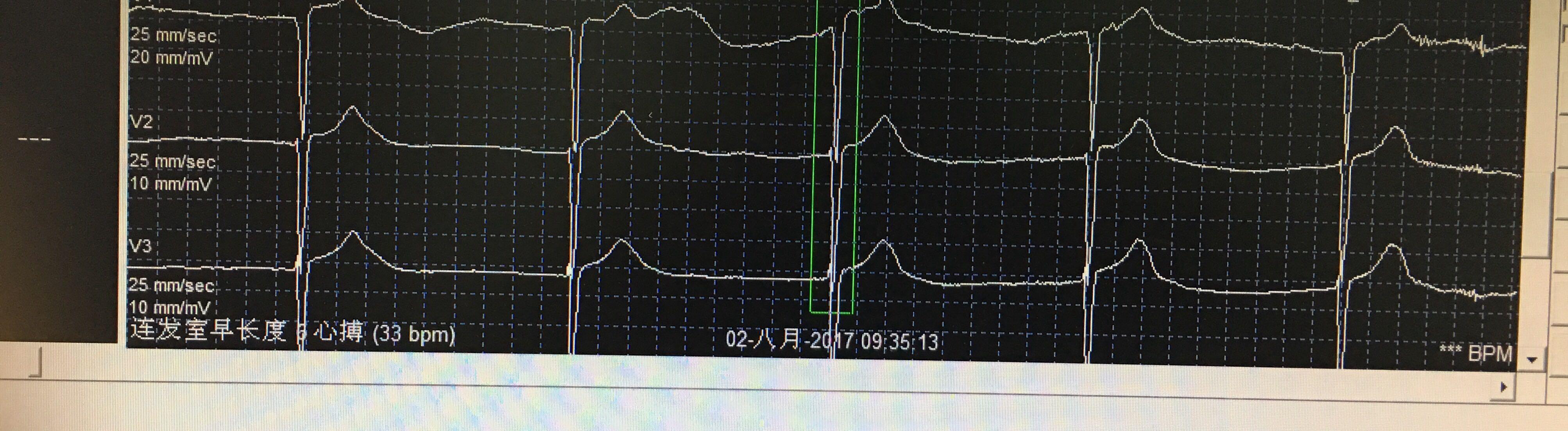 这个是交界性逸搏吗