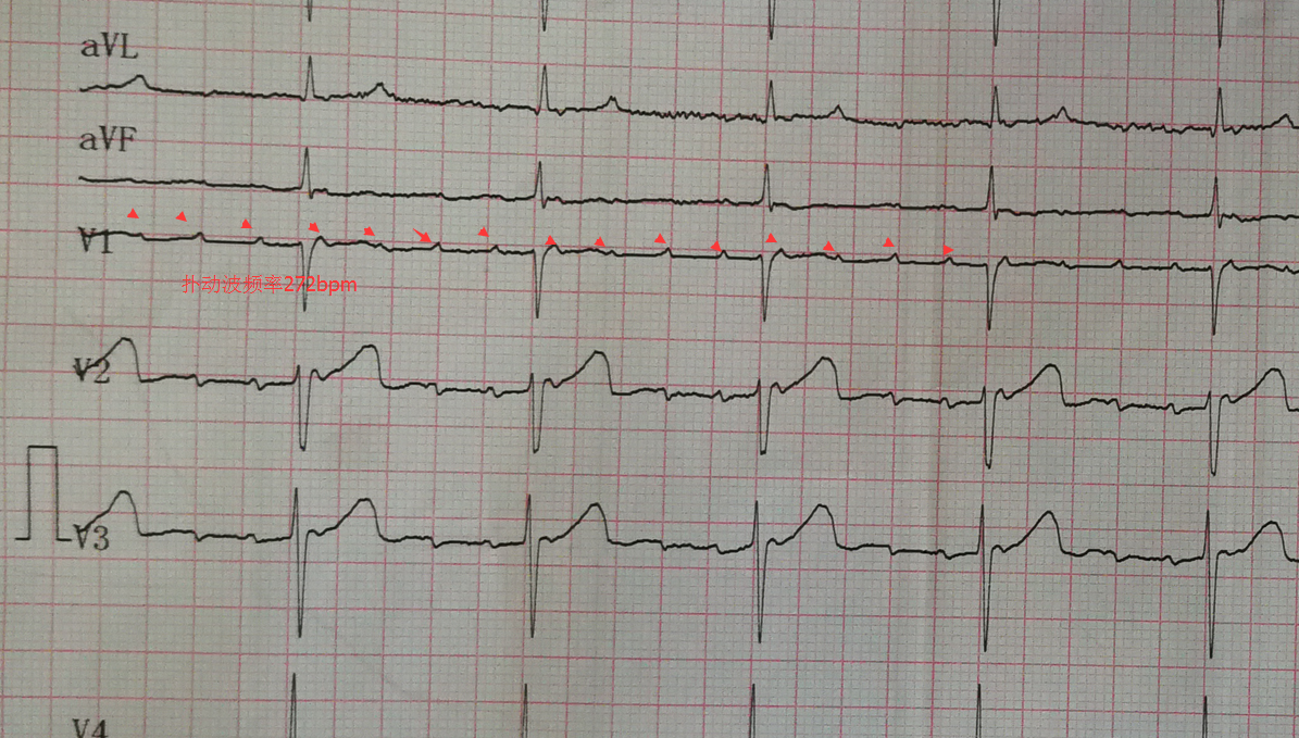 這個圖如何和房撲鑑別 - 心電圖腦電圖專業討論版 - 愛愛醫醫學論壇