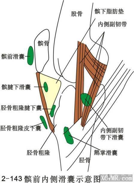 髌前滑囊炎 