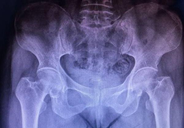无移位的左耻骨上下支骨折如何治疗 骨科与显微外科专业讨论版 爱爱医医学论坛