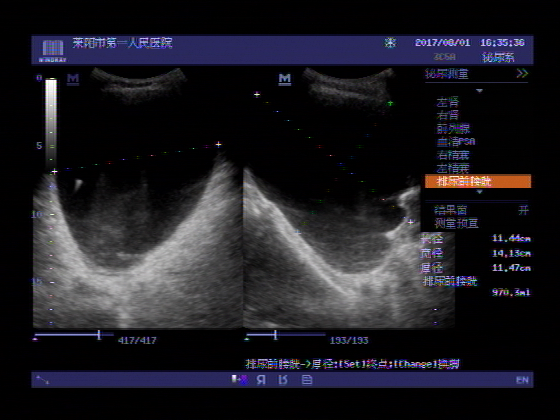 超声入门贴604前列腺增生并急性尿潴留
