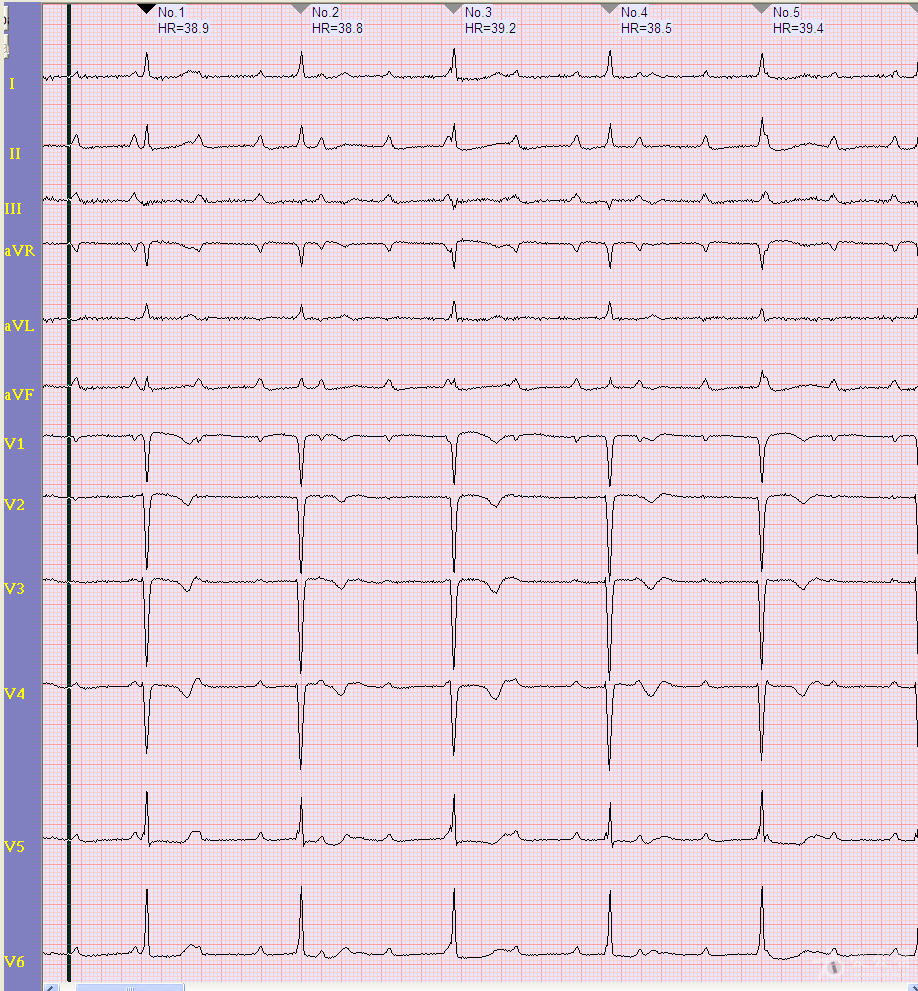 [心电图分析 三度房室阻滞