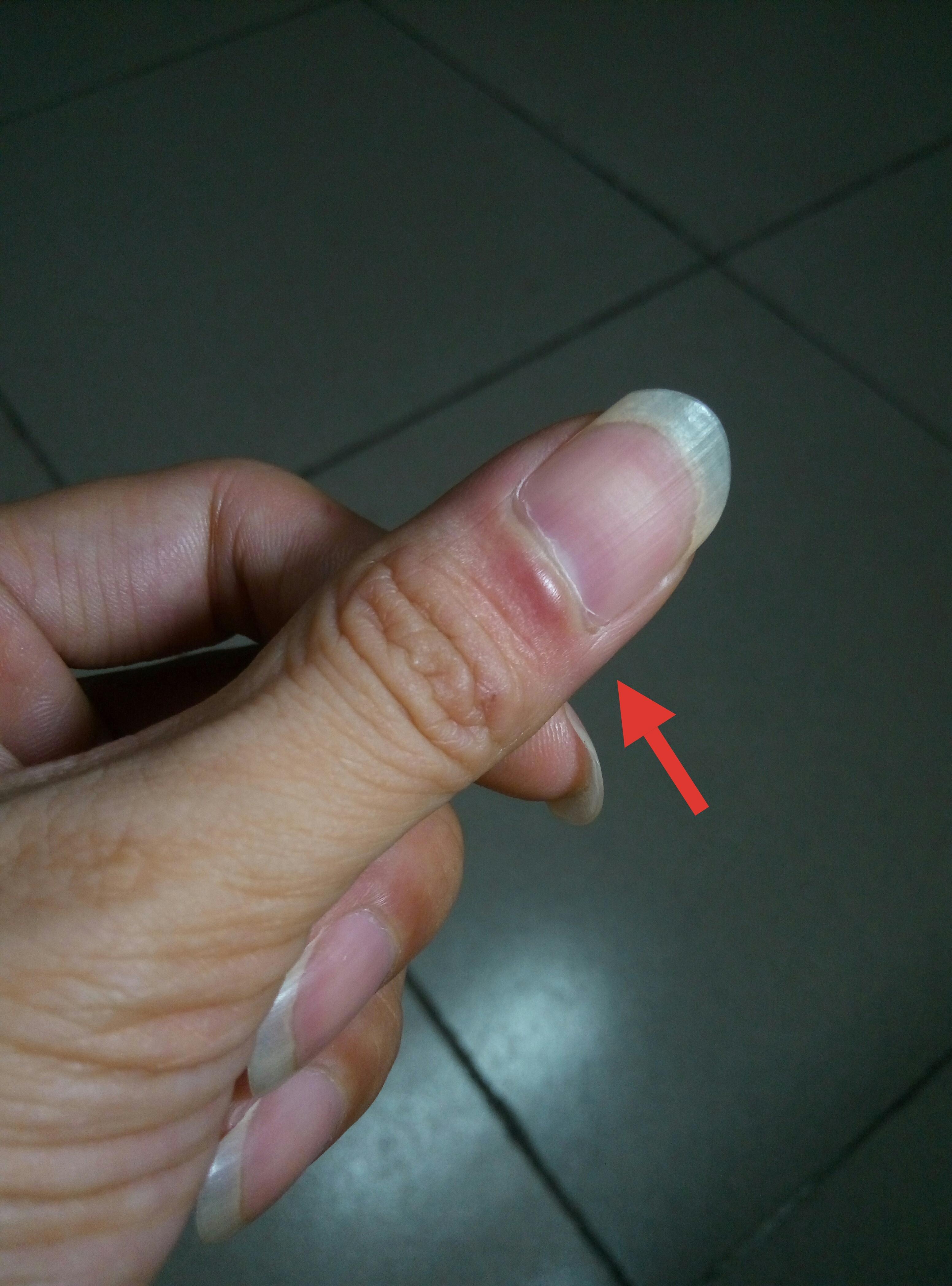手指甲的月牙上方红肿怎么回事