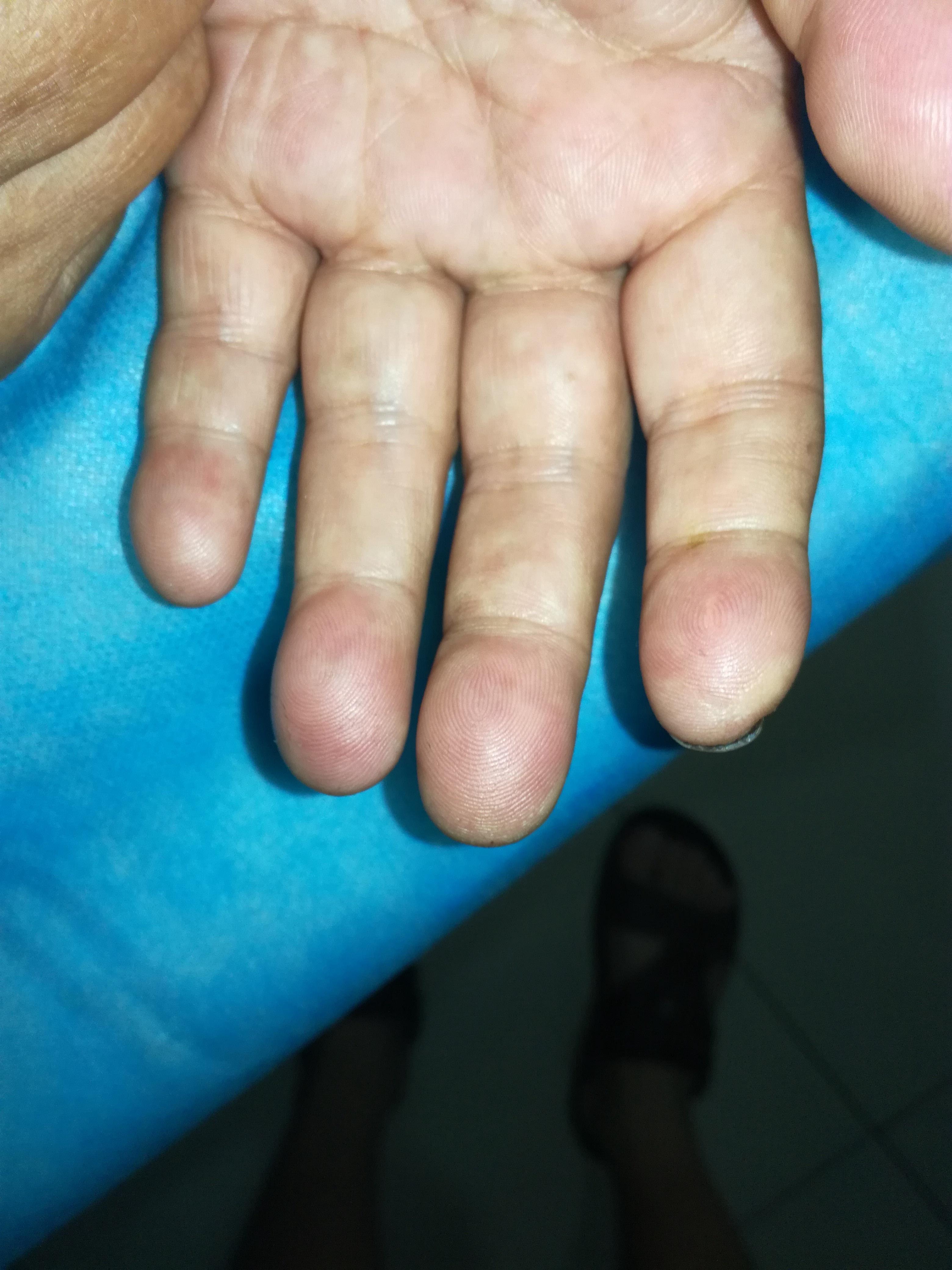 左手指腹肿胀疼痛 大家看看什么病