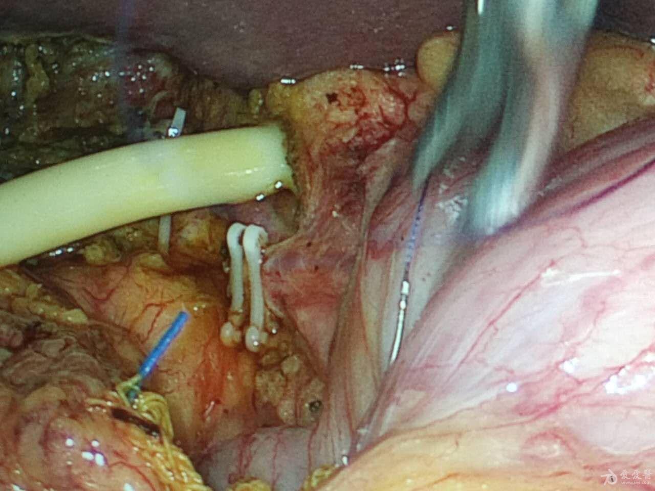 变异胆囊动脉一例