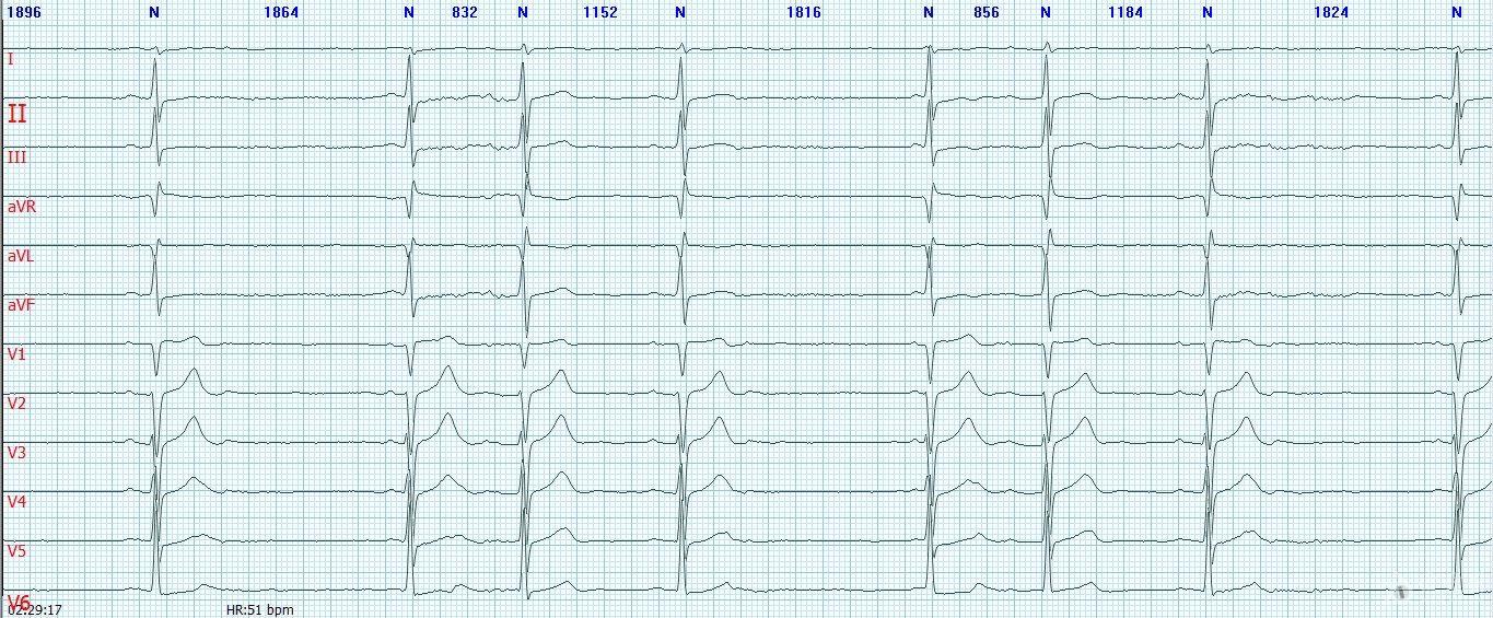 比上不足心電圖交流2是竇性停搏嗎