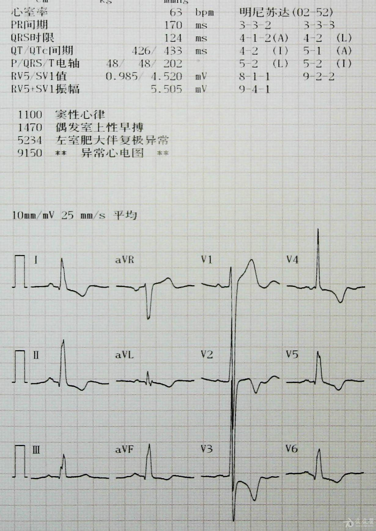 心电图分析不定型室内阻滞