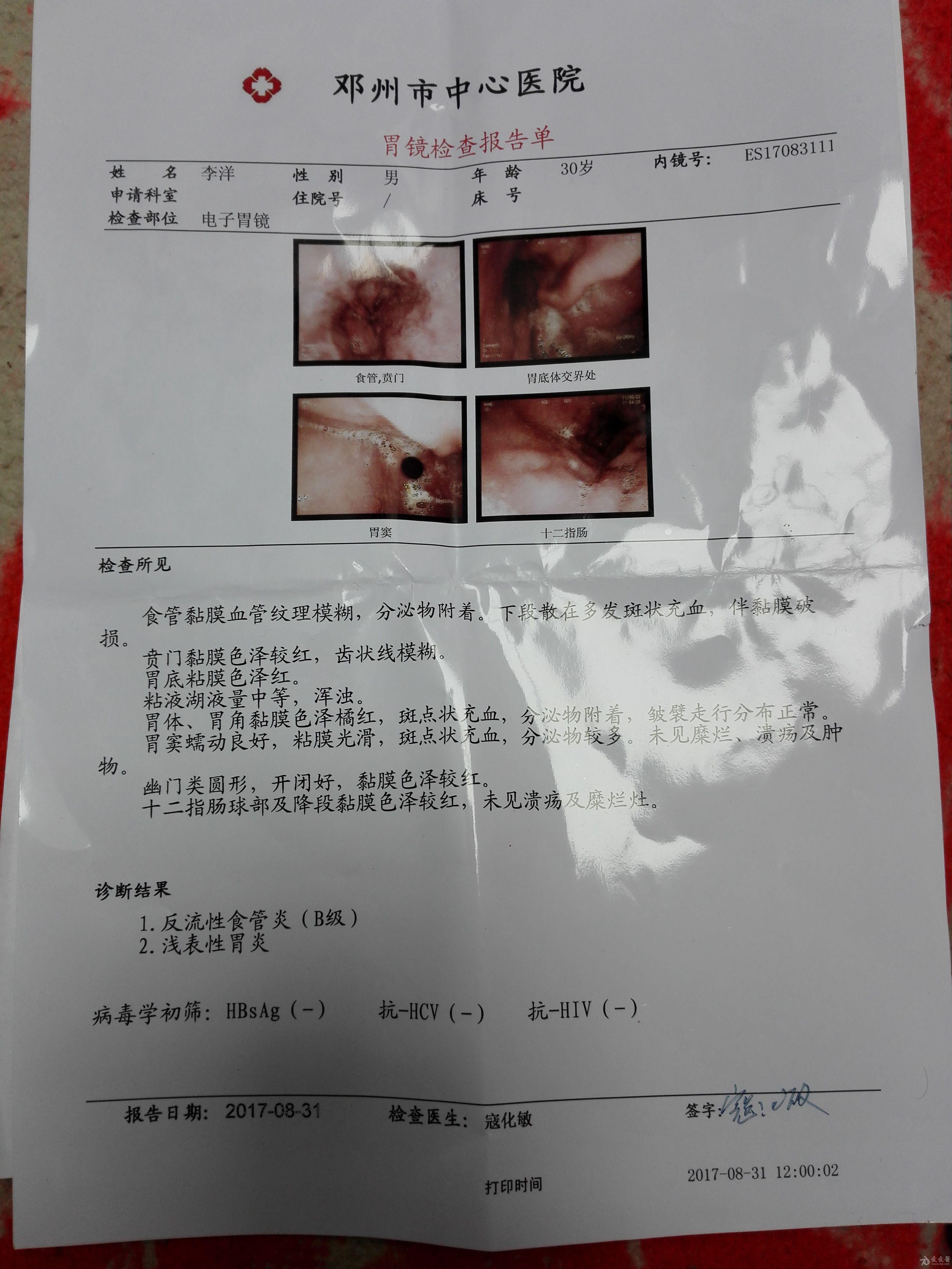 胃癌早期胃镜报告图片图片