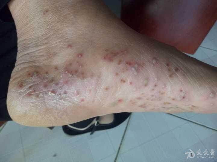 有奖猜图积分大派送229脓疱性细菌疹