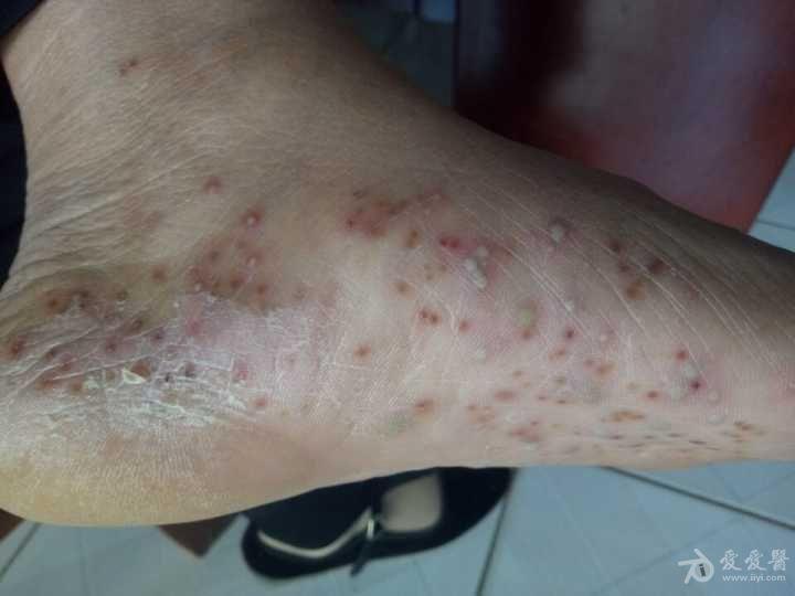 有奖猜图积分大派送229脓疱性细菌疹