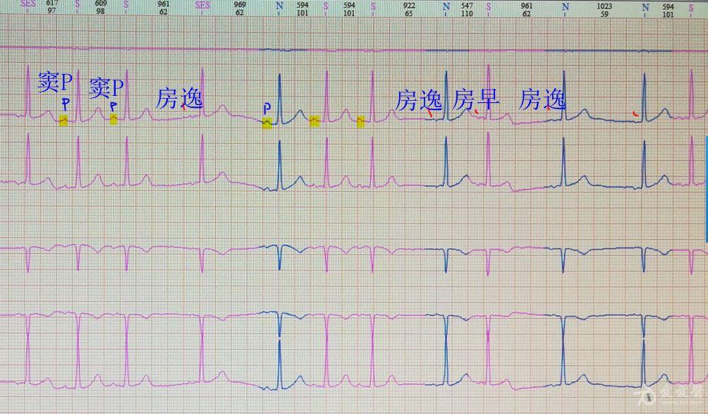 请教:房性心律失常分析 - 心电图脑电图专业讨论版 - 爱爱医医学论坛