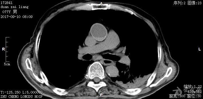 ct图像示心脏大血管内血液密度呈分层改变 - 医学影像学讨论版 - 爱爱