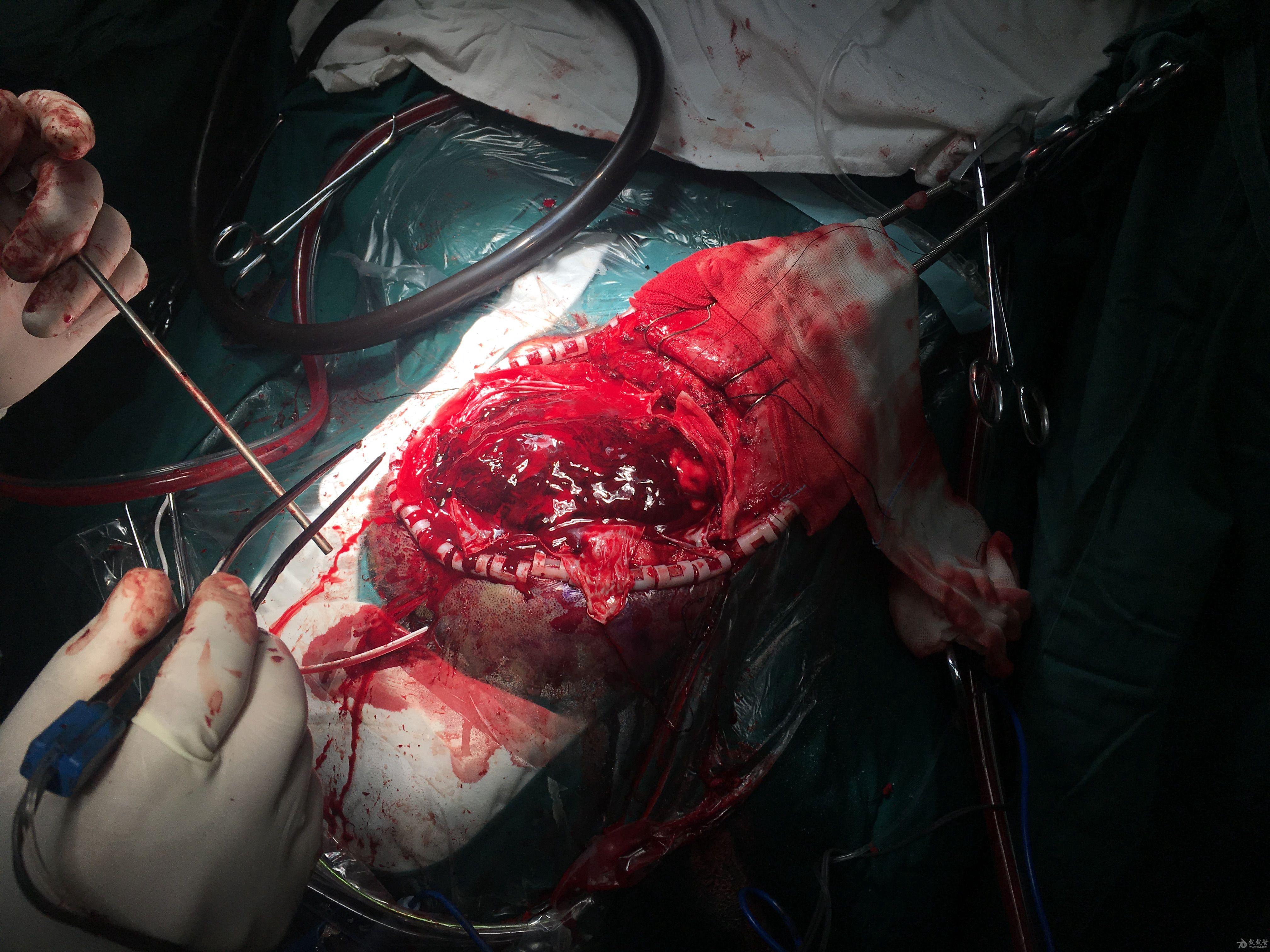 分享重型颅脑损伤双侧去骨瓣病例1则 - 神经外科专业